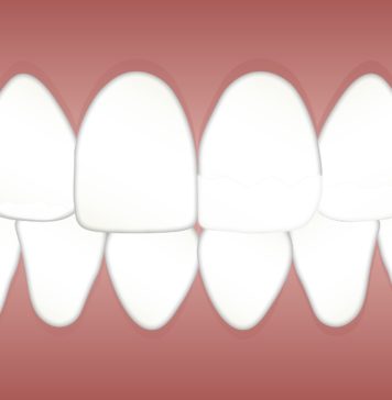 Wybielanie zębów lampą – co warto wiedzieć? grafika przedstawiająca zęby