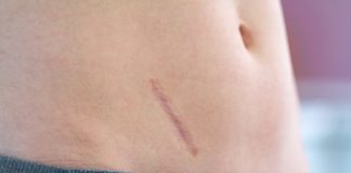 Po co nam wyrostek robaczkowy? wyrostek robaczkowy blizna po zabiegu