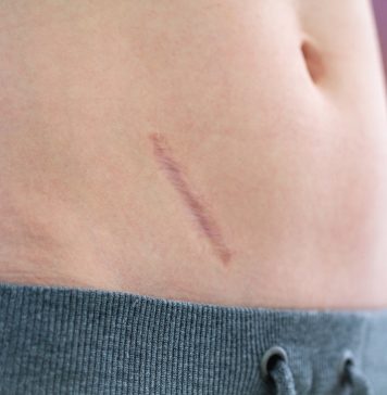 Po co nam wyrostek robaczkowy? wyrostek robaczkowy blizna po zabiegu