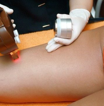 Laserowe usuwanie owłosienia – co warto wiedzieć laserowe usuwanie owłosienia