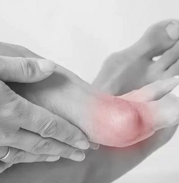 Paluch sztywny – przyczyny, objawy, leczenie paluch sztywny