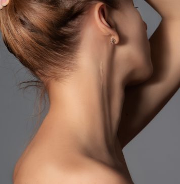 Jak pielęgnować blizny blizna na szyi