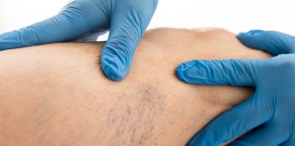 Pajączki a żylaki – jak je odróżnić? Nieinwazyjne sposoby na żylaki Pajączki naczyniowe. Teleangiektazje. Choroby skóry.